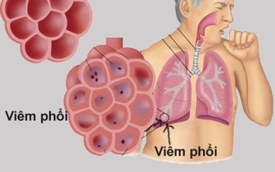 Căn bệnh gây tử vong hàng đầu ở trẻ, cha mẹ cần nhớ các dấu...